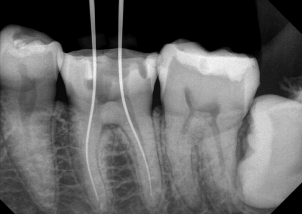 Extraordinary Intraoral Sensor Model : PortView - Image 12