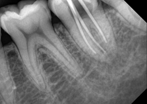 Extraordinary Intraoral Sensor Model : PortView - Image 4