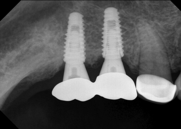 Extraordinary Intraoral Sensor Model : PortView - Image 3